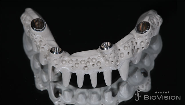 Pekkton Substructure with Pink Hybrid Resin & Individual Press Crowns