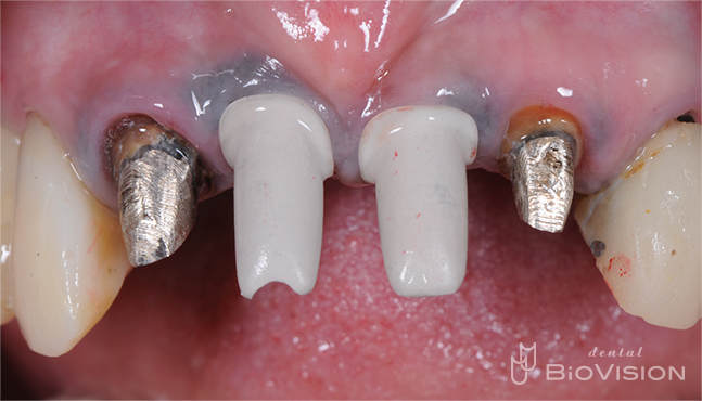 Cement retain superstructure and monolithic zirconia crown