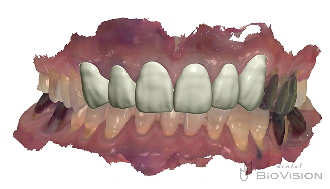 Maxillary 6 anterior teeth monolithic zirconia crown