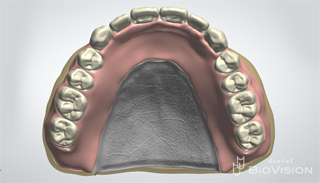 Maxillary metal plate full denture