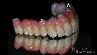 Screw Retained Monolithic Zirconia Br with Pink Porcelain
