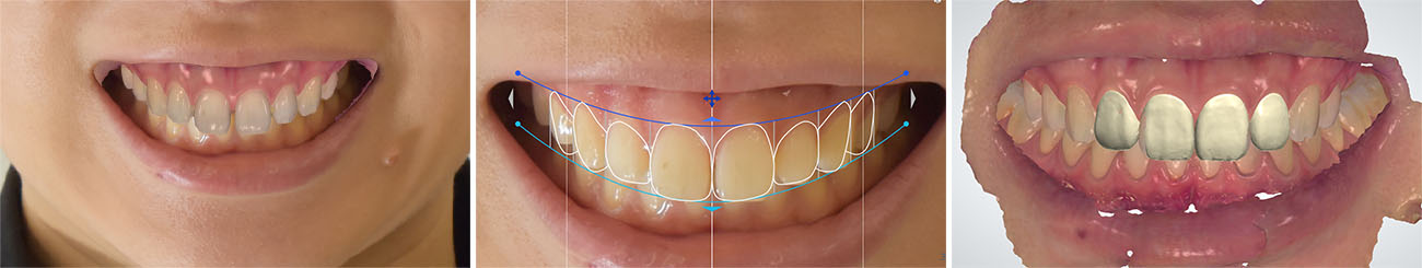上顎前歯天然歯デジタル診断