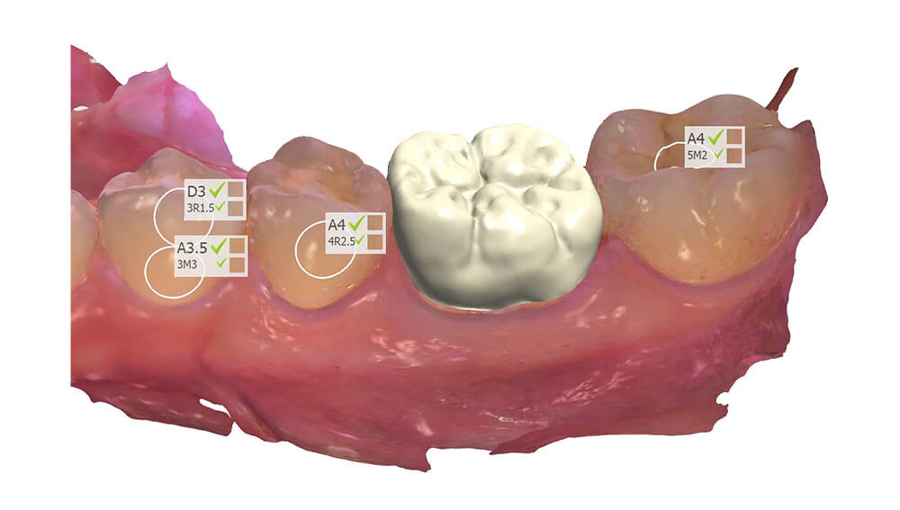 INTRAORAL SCANNER