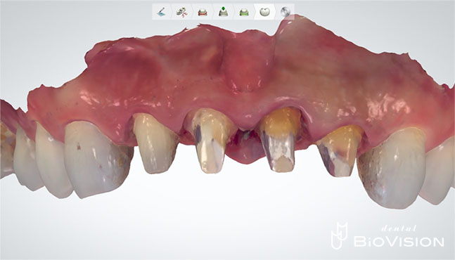 Half Layered Zirconia Ceramic Crowns