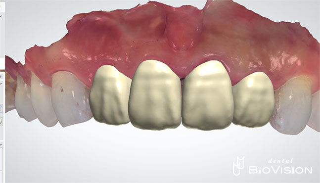 Half Layered Zirconia Ceramic Crowns