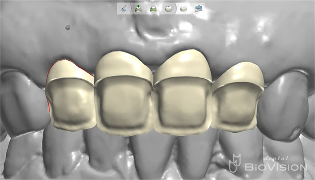 Half Layered Zirconia Ceramic Crowns