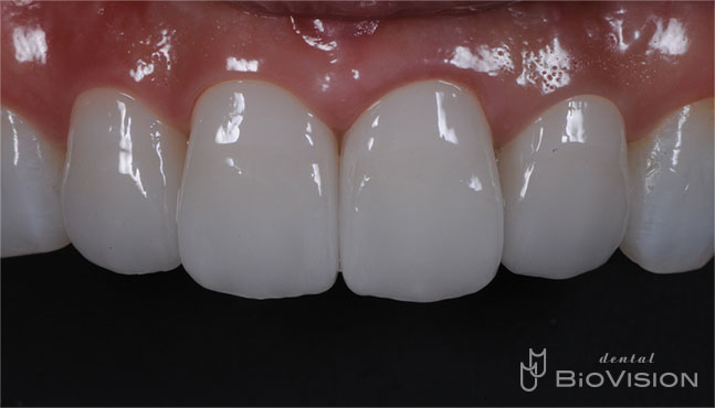 Half Layered Zirconia Ceramic Crowns