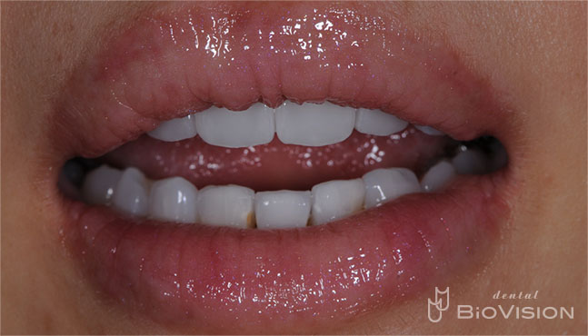 Half Layered Zirconia Ceramic Crowns