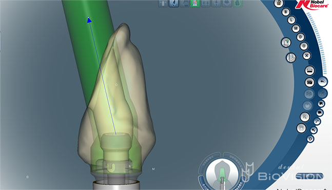 Layered Zirconia Ceramic with ASC Abutment