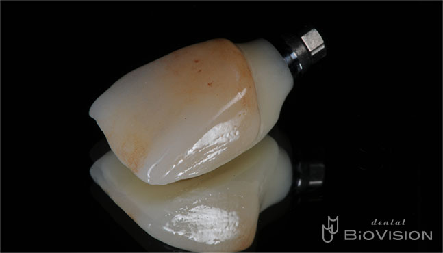 Layered Zirconia Ceramic with ASC Abutment