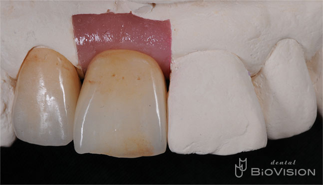 Layered Zirconia Ceramic with ASC Abutment