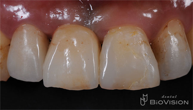 Layered Zirconia Ceramic with ASC Abutment