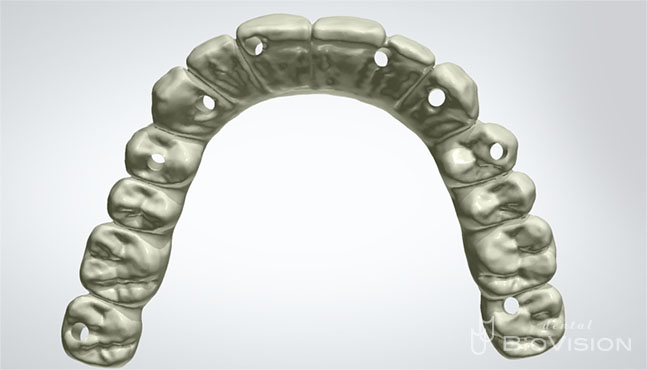 Screw Retain Full Zirconia Bridge with Pink Porcelain