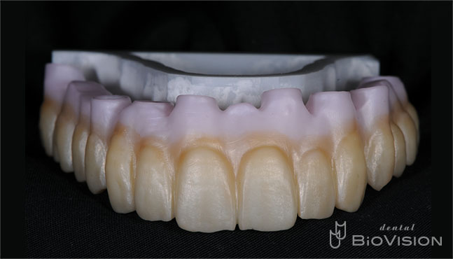 Screw Retain Full Zirconia Bridge with Pink Porcelain