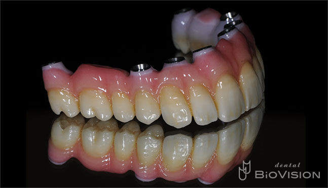 Screw Retain Full Zirconia Bridge with Pink Porcelain