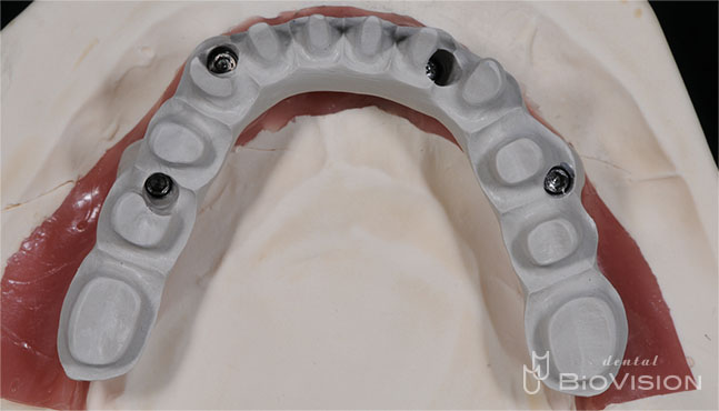 Pekkton Substructure with Pink Hybrid Resin & Individual Press Crowns