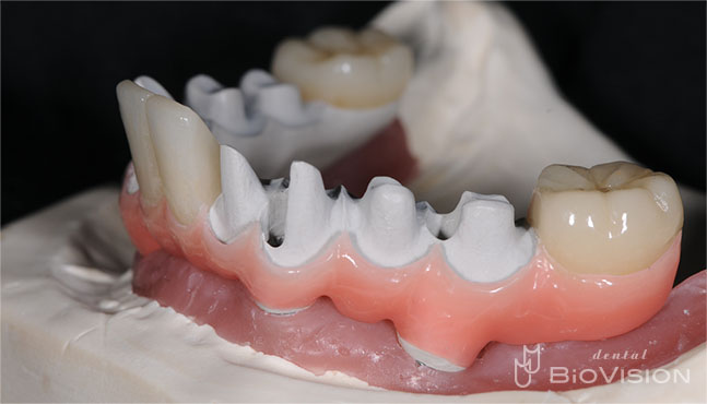 Pekkton Substructure with Pink Hybrid Resin & Individual Press Crowns