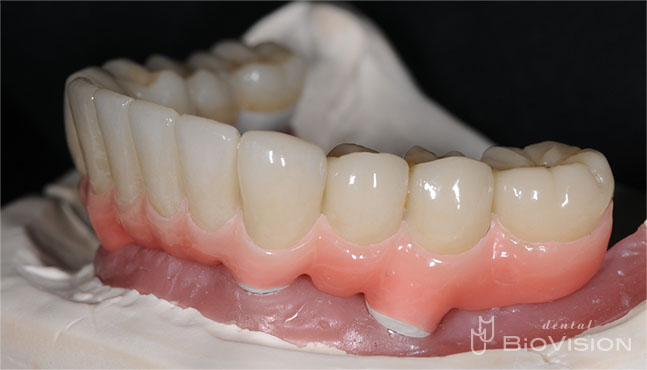 Pekkton Substructure with Pink Hybrid Resin & Individual Press Crowns