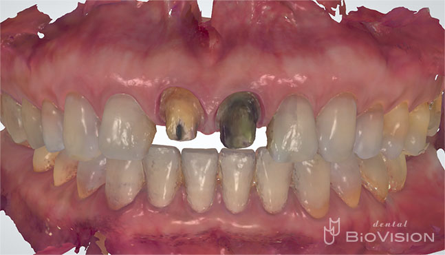 Layered Zirconia Ceramic Crowns by Intra Oral Scanner