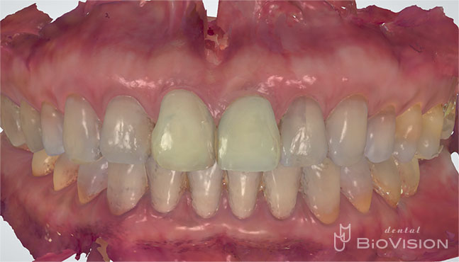 Layered Zirconia Ceramic Crowns by Intra Oral Scanner