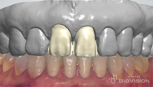 Layered Zirconia Ceramic Crowns by Intra Oral Scanner