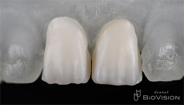 Layered Zirconia Ceramic Crowns by Intra Oral Scanner