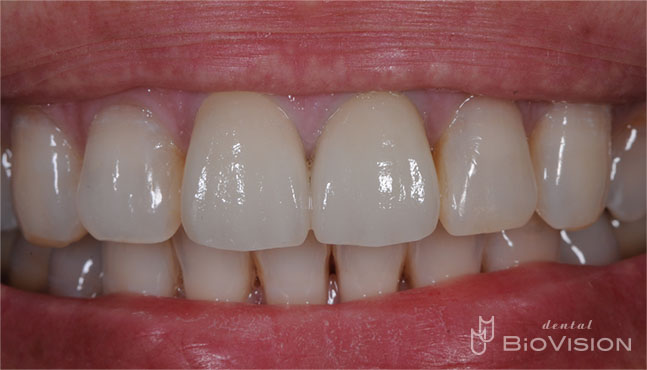 Layered Zirconia Ceramic Crowns by Intra Oral Scanner