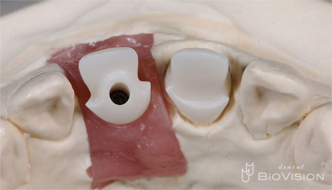 Layered Zirconia Ceramic Cr & Screw Retained Zirconia Ceramic