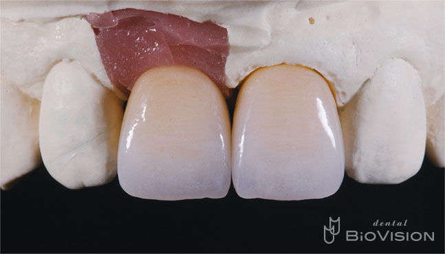 Layered Zirconia Ceramic Cr & Screw Retained Zirconia Ceramic