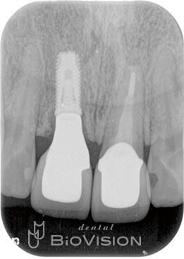 Layered Zirconia Ceramic Cr & Screw Retained Zirconia Ceramic