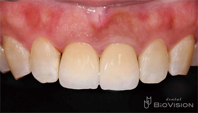 Layered Zirconia Ceramic Cr & Screw Retained Zirconia Ceramic