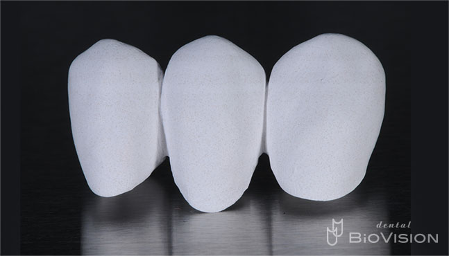 Full Anatomic Zirconia Bridge