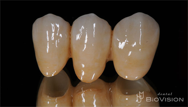 Full Anatomic Zirconia Bridge