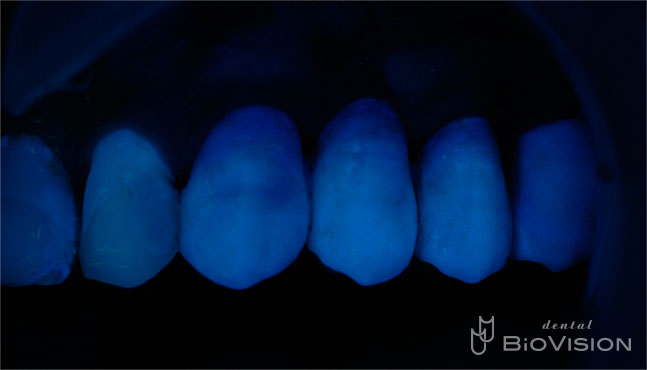 Full Anatomic Zirconia Bridge