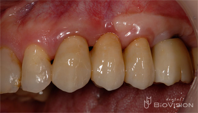 Full Anatomic Zirconia Bridge