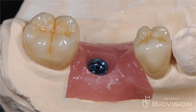 Full Anatomic Zirconia Crowns & Screw Retained Full Zirconia