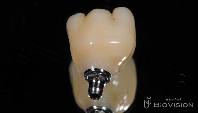 Full Anatomic Zirconia Crowns & Screw Retained Full Zirconia