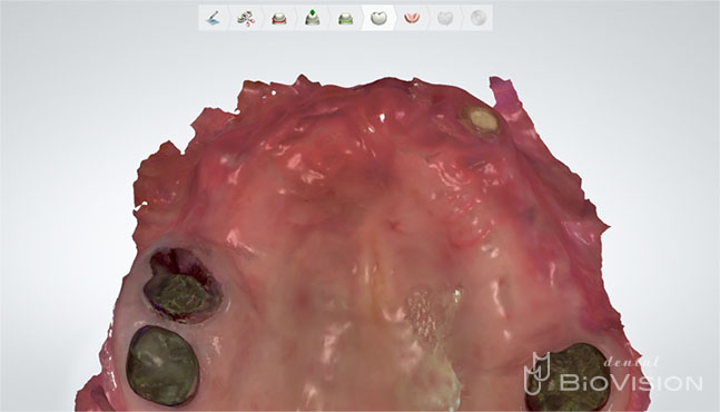 Diagnostic by Digital Design & Milled PMMA Resin up