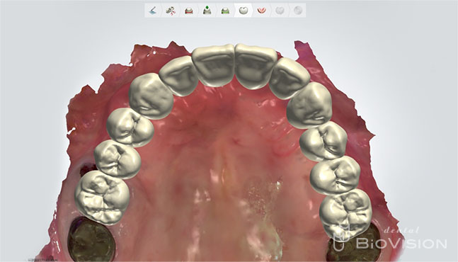 Diagnostic by Digital Design & Milled PMMA Resin up