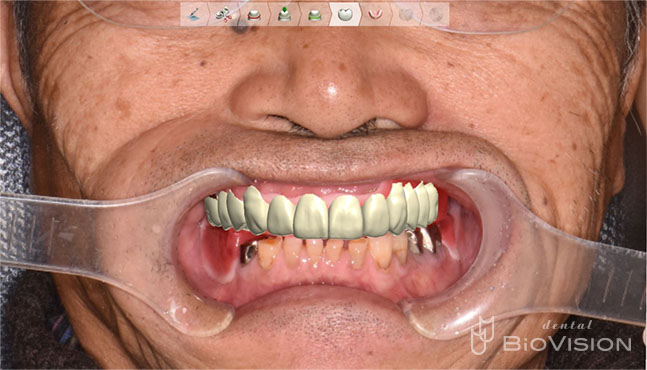 Diagnostic by Digital Design & Milled PMMA Resin up