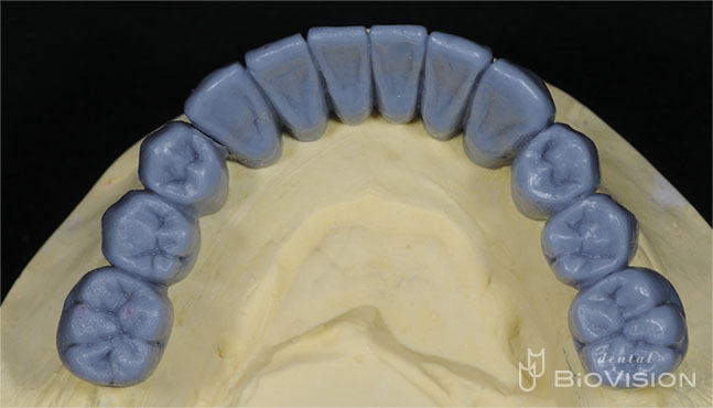 3segments Screw Retained Monolithic Zirconia Bridge