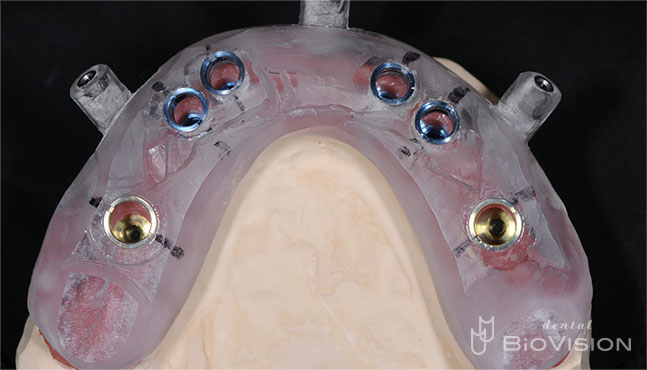 3segments Screw Retained Monolithic Zirconia Bridge