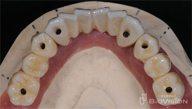 3segments Screw Retained Monolithic Zirconia Bridge