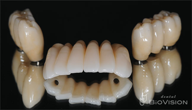 3segments Screw Retained Monolithic Zirconia Bridge