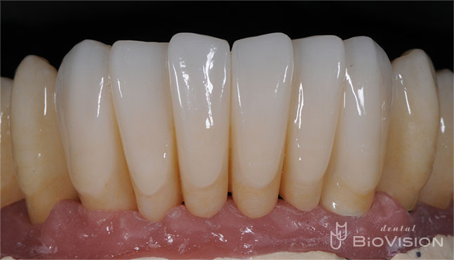 3segments Screw Retained Monolithic Zirconia Bridge