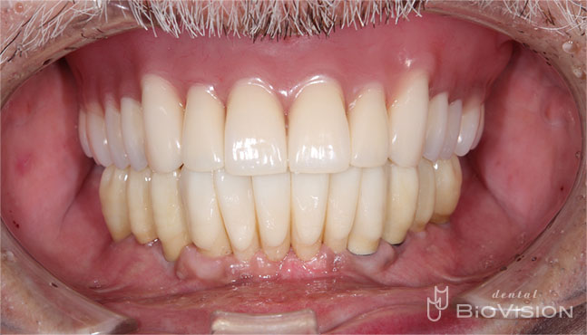 3segments Screw Retained Monolithic Zirconia Bridge