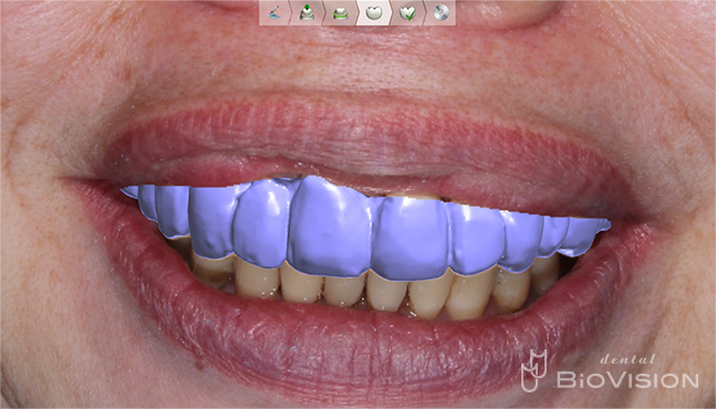 Zirconia Prosthesis with Full Digital Design