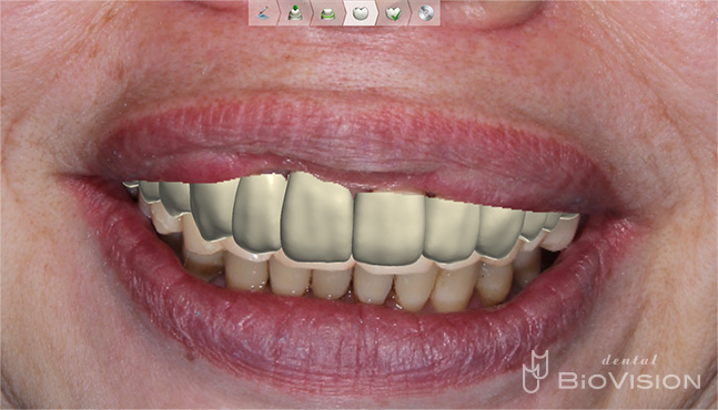 Zirconia Prosthesis with Full Digital Design