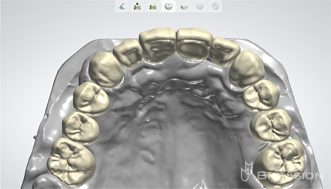 Zirconia Prosthesis with Full Digital Design