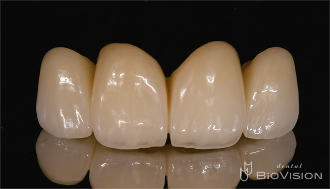 Zirconia Prosthesis with Full Digital Design